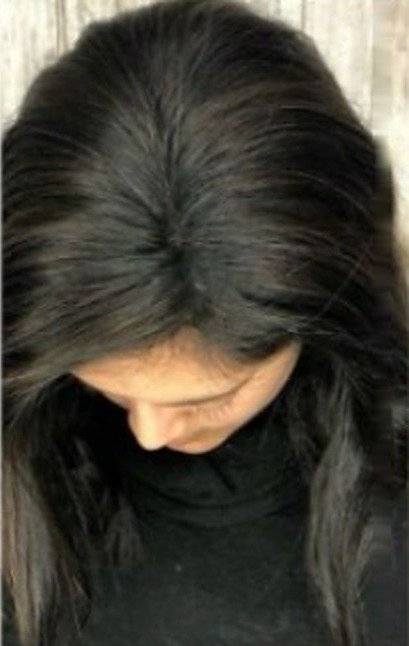PRP hair therapy — after treatment