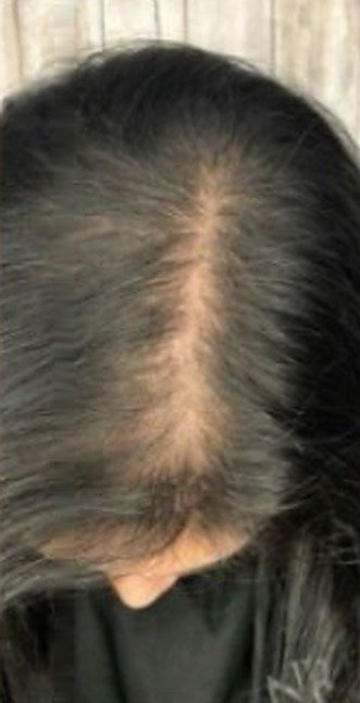 PRP hair therapy — before treatment
