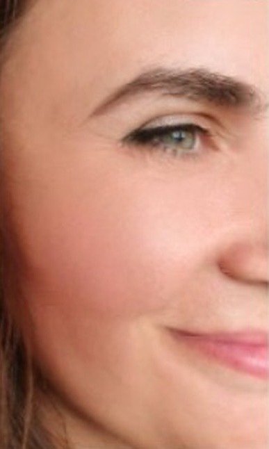 Skin rejuvenation — after treatment