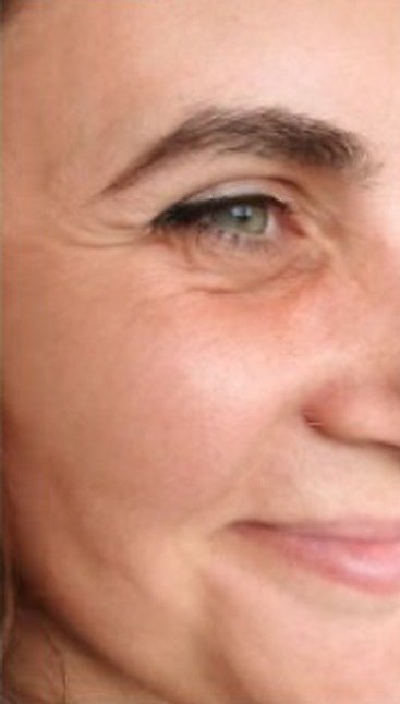 Skin rejuvenation — before treatment