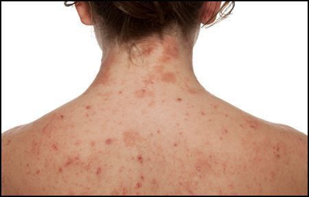 Scabies Treatment in Multan