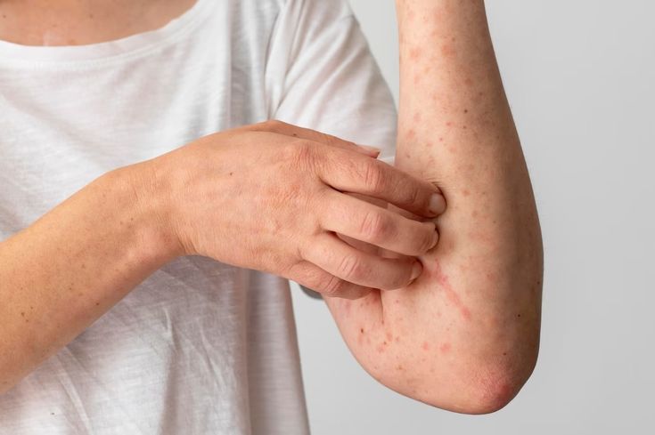 Scabies treatment Multan — skin doctor