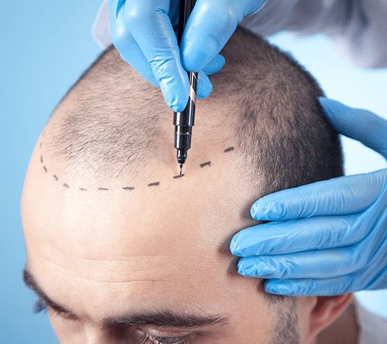 FUE Hair Transplant
