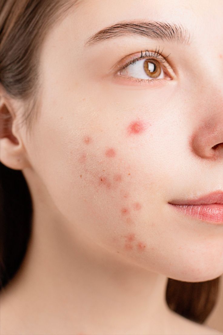 acne treatment in multan