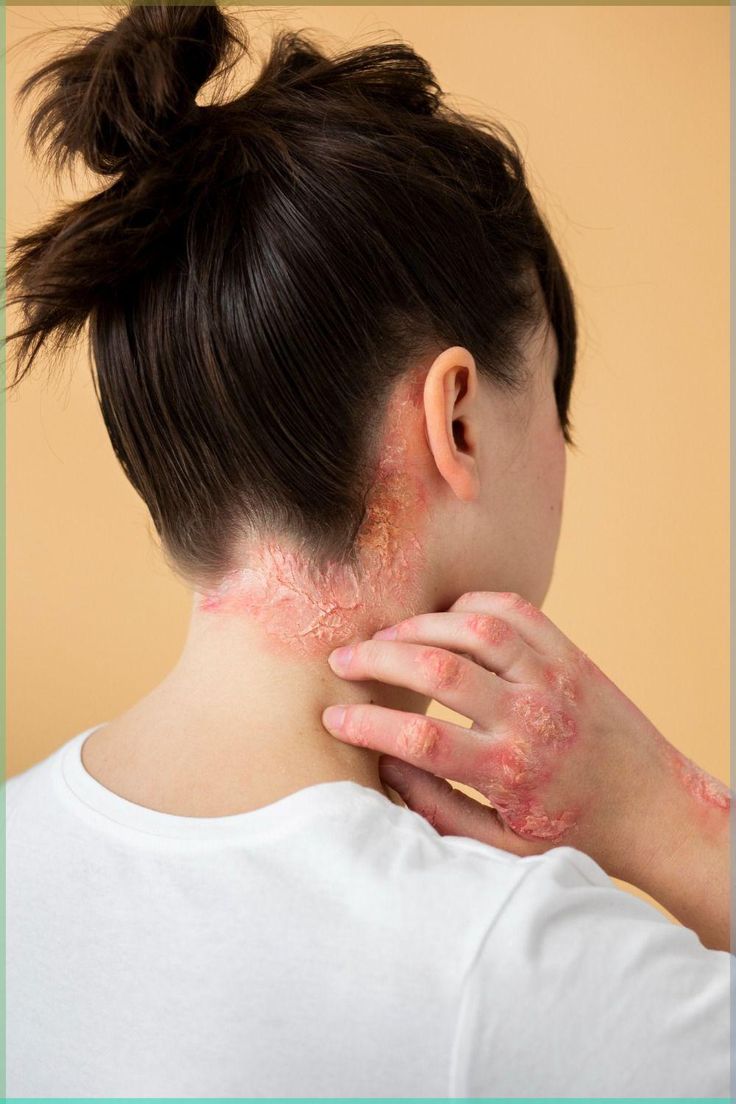 Psoriasis Treatment in Multan